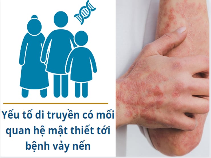 Nguyên nhân bệnh vảy nến và cách cải thiện hiệu quả, tránh tái phát