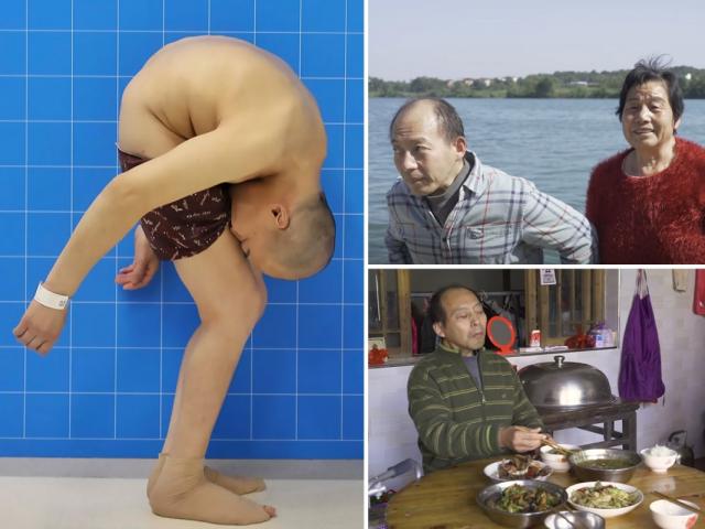 TQ: Liều mạng phẫu thuật, người đàn ông 'gập đôi' gặp điều kỳ diệu